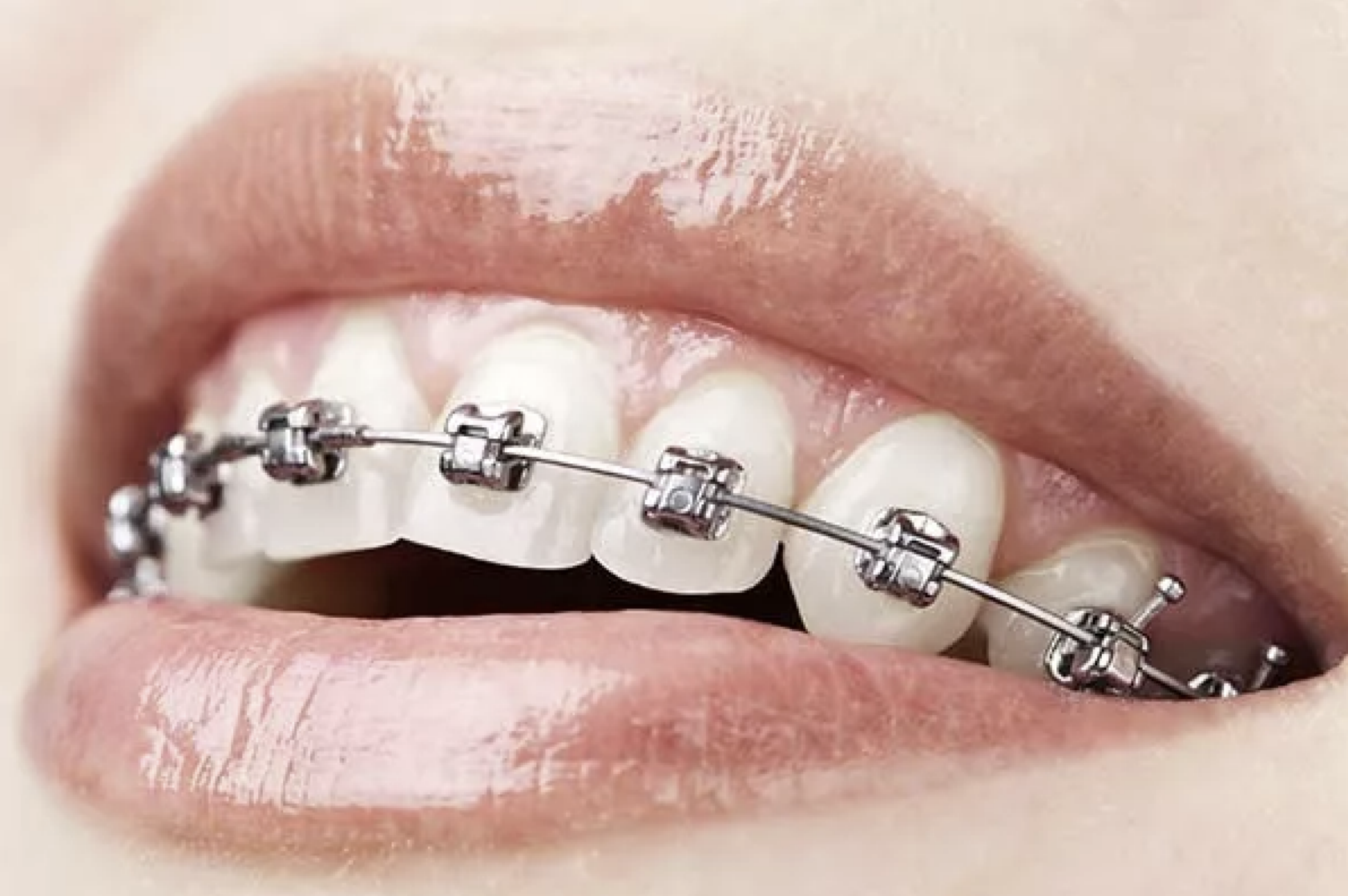 A confident smile starts with the right alignment – braces in action!